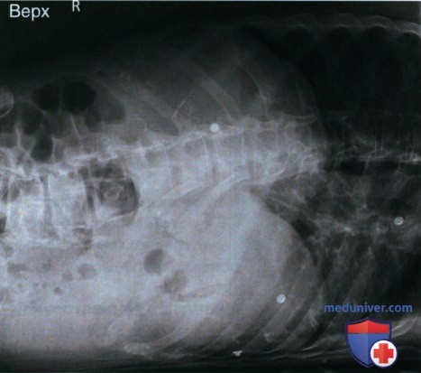 Рекомендации по анализу рентгенограммы органов брюшной полости (ОБП) лежа на боку в ПЗ проекции