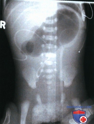 Укладка при рентгенограмме органов брюшной полости (ОБП) у новорожденных и грудных детей лежа на спине