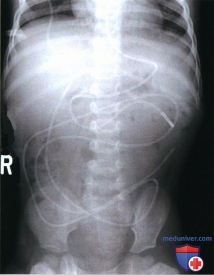 Укладка при рентгенограмме органов брюшной полости (ОБП) у новорожденных и грудных детей лежа на спине