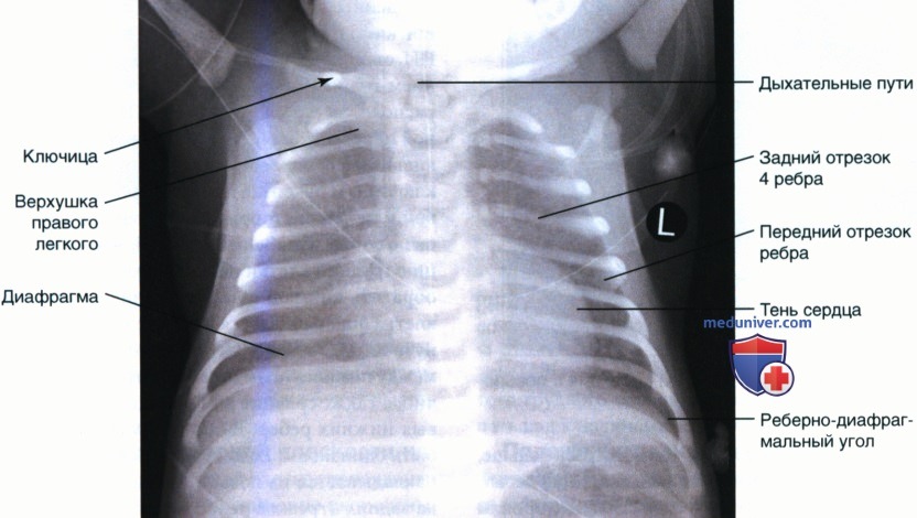 Укладка при рентгенограмме органов грудной клетки (ОГК) новорожденных и грудных детей в передне-задней проекции (ПЗ)