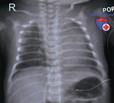 Рекомендации по анализу рентгенограммы органов грудной клетки (ОГК) новорожденных и грудных детей в передне-задней проекции (ПЗ)