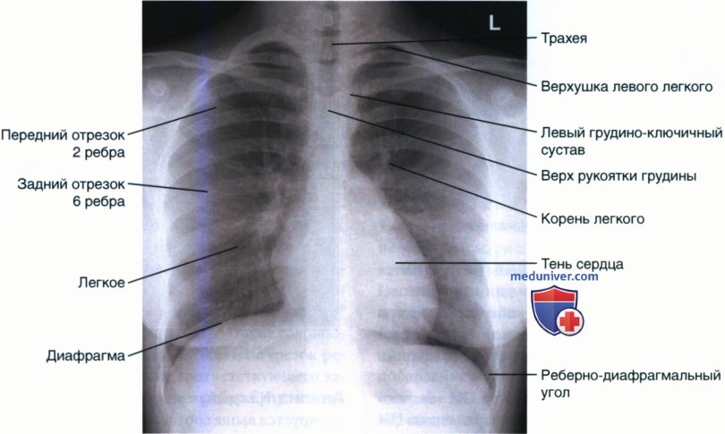 Укладка при рентгенограмме органов грудной клетки (ОГК) у детей старшего возраста в задне-передней и передне-задней проекции (ЗП и ПЗ)