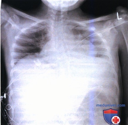 Рекомендации по анализу рентгенограммы органов грудной клетки (ОГК) у детей старшего возраста в задне-передней и передне-задней проекции (ЗП и ПЗ)