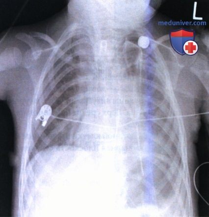 Рекомендации по анализу рентгенограммы органов грудной клетки (ОГК) у детей старшего возраста в задне-передней и передне-задней проекции (ЗП и ПЗ)