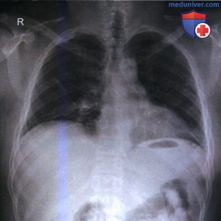 Укладка при рентгенограмме органов грудной клетки (ОГК) лежа на спине (передне-задней проекции)