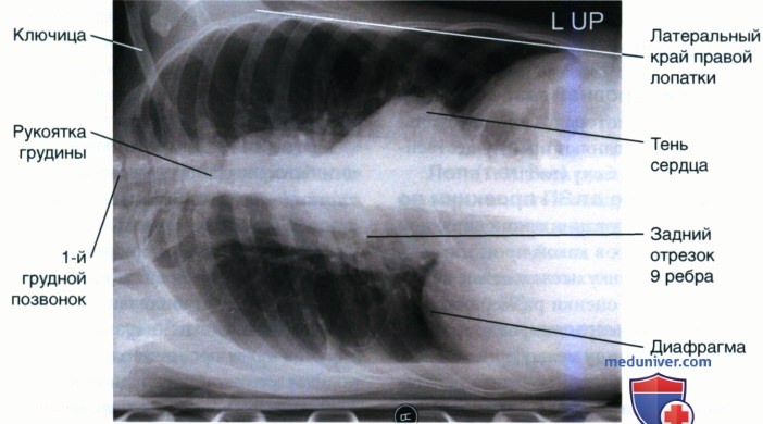 Укладка при рентгенограмме органов грудной клетки (ОГК) лежа на боку (правом или левом)