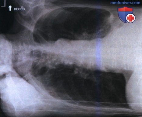 Укладка при рентгенограмме органов грудной клетки (ОГК) лежа на боку (правом или левом)