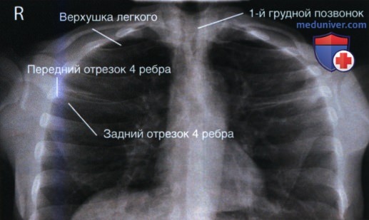 Укладка при рентгенограмме органов грудной клетки (ОГК) в аксиальной (лордотической) ПЗ проекции