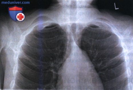 Укладка при рентгенограмме органов грудной клетки (ОГК) в аксиальной (лордотической) ПЗ проекции