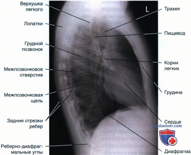 Укладка при рентгенограмме органов грудной клетки (ОГК) в боковой проекции (левой)