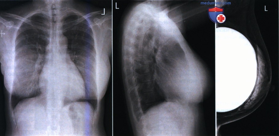 Рекомендации по анализу рентгенограммы органов грудной клетки в задне-передней проекции (прямой)