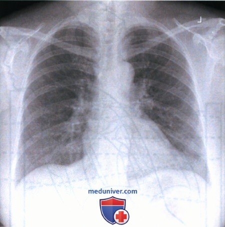 Укладка при рентгенограмме органов грудной клетки (ОГК) в задне-передней проекции