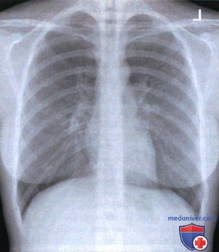 Укладка при рентгенограмме органов грудной клетки (ОГК) в задне-передней проекции