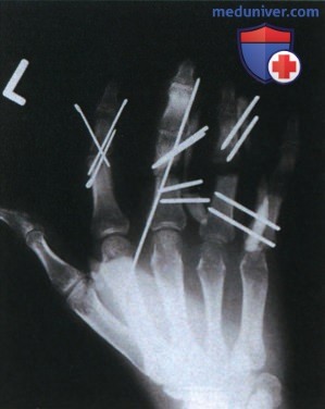Рекомендации по анализу рентгенограммы пальца руки в ЗП проекции