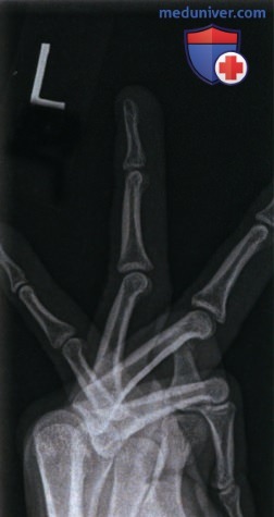 Рекомендации по анализу рентгенограммы пальца кисти в боковой проекции