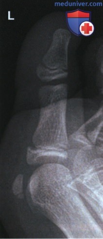 Укладка при рентгенограмме пальца стопы в боковой проекции