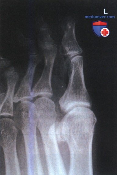 Укладка при рентгенограмме пальца стопы в боковой проекции