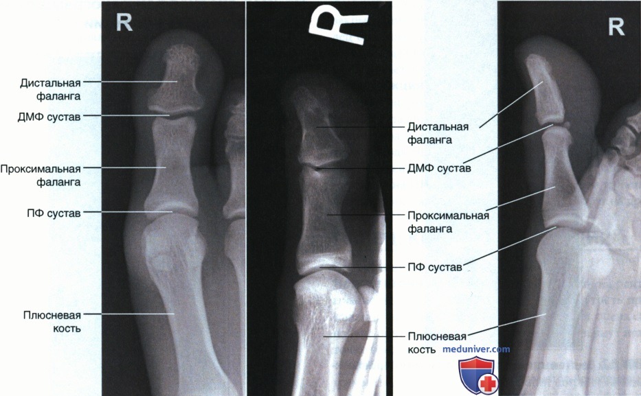Укладка при рентгенограмме пальца ноги в аксиальной ПЗ проекции
