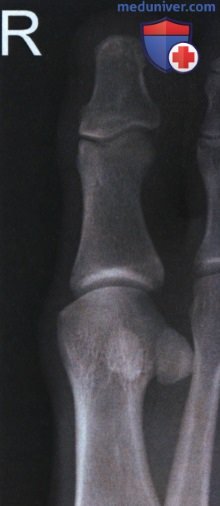 Укладка при рентгенограмме пальца ноги в аксиальной ПЗ проекции