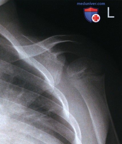 Укладка при рентгенограмме плечевого сустава в косой ПЗ проекции (метод Грэши)