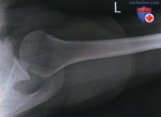 Укладка при рентгенограмме плечевого сустава в нижневерхней аксиальной проекции (метод Лоуренса)