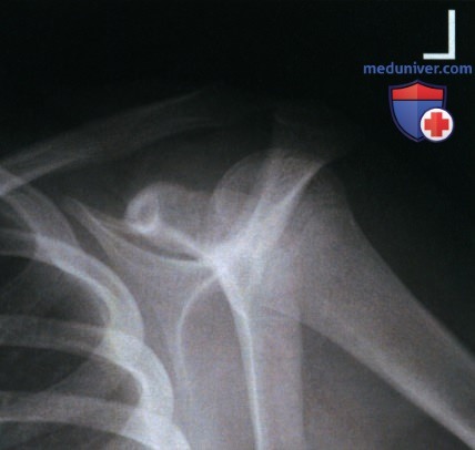 Укладка при рентгенограмме плечевого сустава в тангенциальной проекции надостного отверстия (метод Нира)