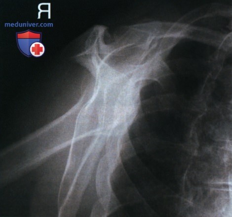 Укладка при рентгенограмме плечевого сустава в тангенциальной проекции надостного отверстия (метод Нира)