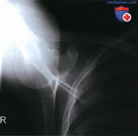 Рекомендации по анализу рентгенограммы плечевого сустава в аксиальной ПЗ проекции (метод Страйкера)
