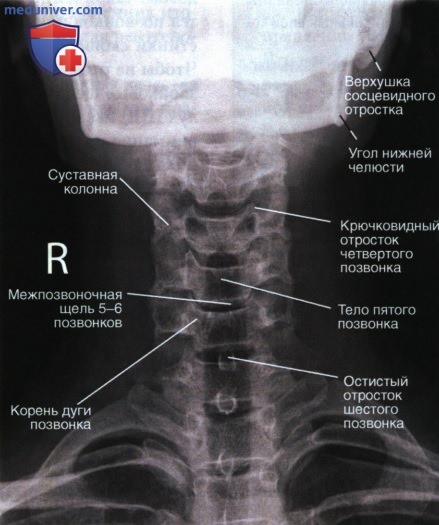 Укладка при рентгенограмме шейных позвонков в аксиальной ПЗ проекции