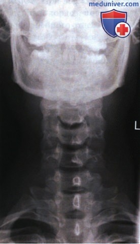 Рентгенограмма шейных позвонков в аксиальной ПЗ проекции