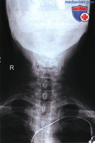 Укладка при рентгенограмме шейных позвонков в аксиальной ПЗ проекции