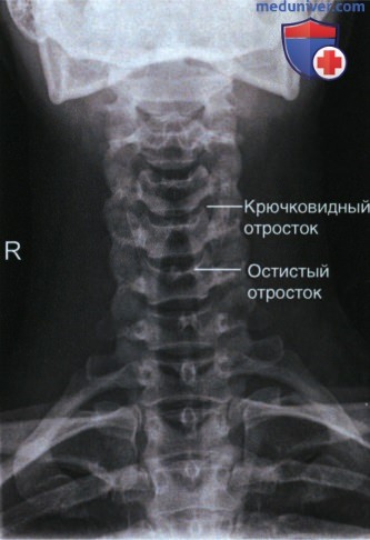 Рентгенограмма шейных позвонков в аксиальной ПЗ проекции