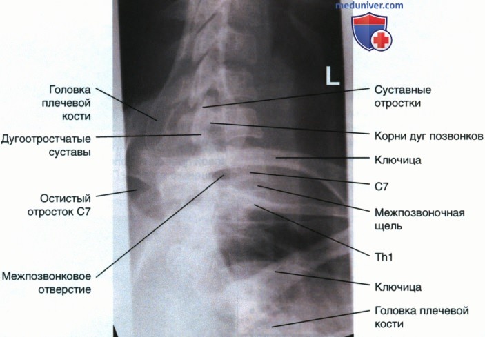 Укладка при рентгенограмме шейно-грудного перехода в боковой проекции (по методу Твайнинга, в позе пловца)