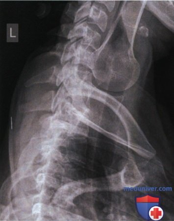 Рентгенограмма шейно-грудного перехода в боковой проекции (по методу Твайнинга, в позе пловца)
