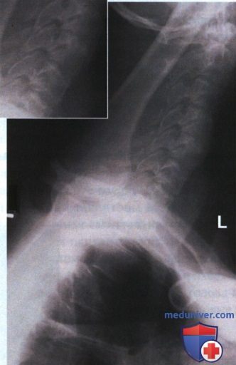 Рентгенограмма шейно-грудного перехода в боковой проекции (по методу Твайнинга, в позе пловца)