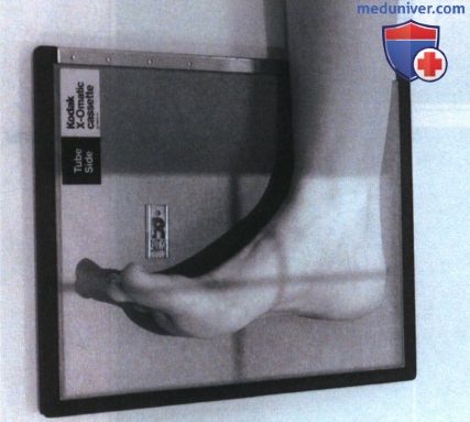 Укладка при рентгенограмме стопы в боковой проекции
