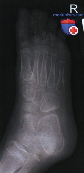 Укладка при рентгенограмме стопы в косой ПЗ проекции (медиальной ротации)