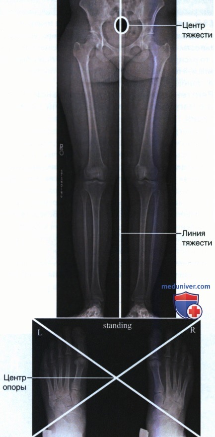 Укладка при рентгенограмме стопы в аксиальной ПЗ проекции (дорсоплантарной)
