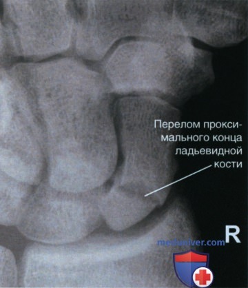 Укладка при рентгенограмме запястья в аксиальной ЗП проекции с ульнарной девиацией (проекция ладьевидной кости)