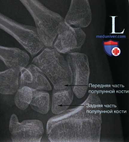 Укладка при рентгенограмме запястья в аксиальной ЗП проекции с ульнарной девиацией (проекция ладьевидной кости)
