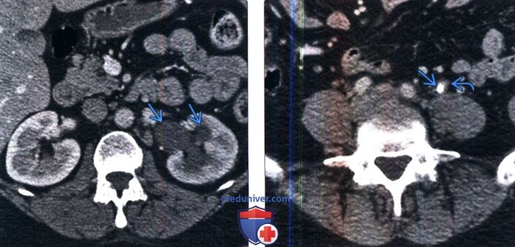 Методы рентгенодиагностики камней почки и мочеточника thumbnail