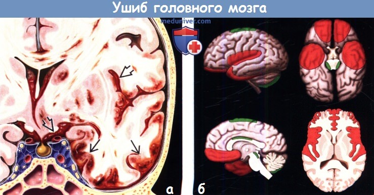 Ушиб головного мозга на КТ