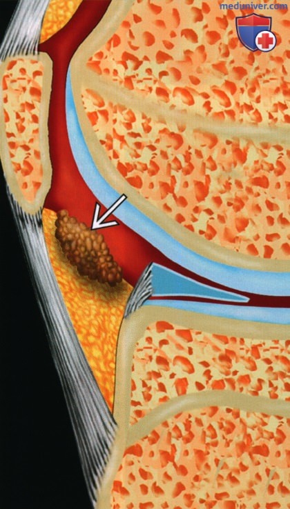 Узелковый внутрисуставной синовит - лучевая диагностика