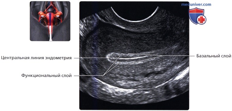 Эндометрий 4 3. Ультразвуковая анатомия матки.