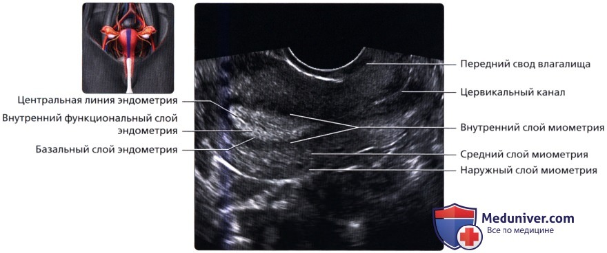 Эндометрий 1 мм. Ультразвуковая анатомия матки и придатков в норме. Сагиттальный срез матки на УЗИ. Продольный срез матки УЗИ.