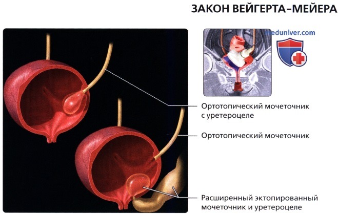 Пузыре или мочеточниках. Уретероцеле цистоскопия. Уретероцеле в Устье левого мочеточника. Ортотопическое уретероцеле. Уретероцеле мочеточника.