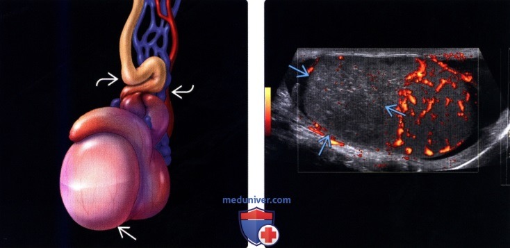 УЗИ при перекруте и инфаркте яичка