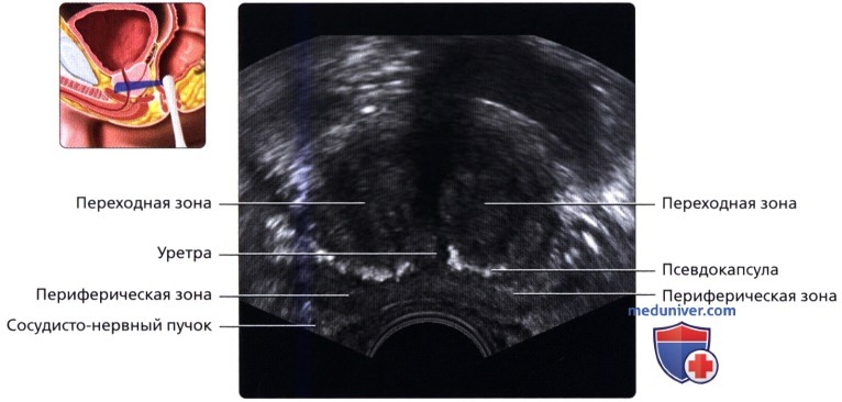 Точка простаты. УЗИ анатомия предстательной железы трансректально. Петрификаты предстательной железы что это. Зональная анатомия предстательной железы УЗИ. Гиперплазия предстательной железы УЗИ.