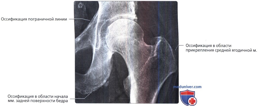 Варианты нормы таза, тазобедренного сустава на рентгенограмме, МРТ