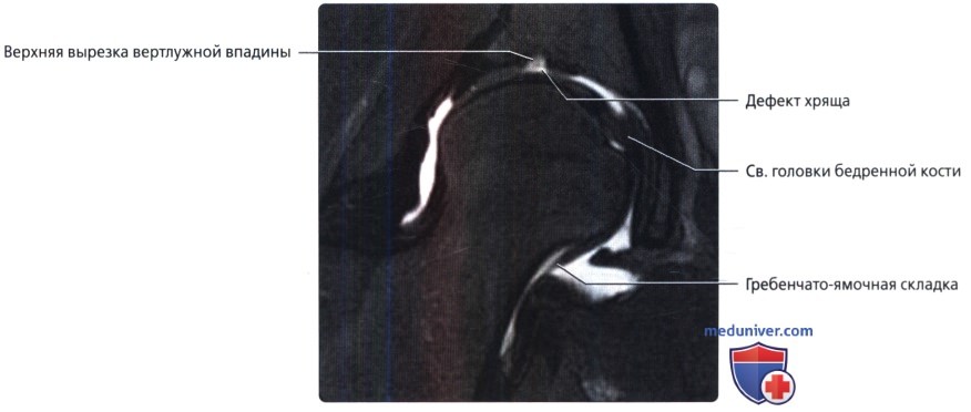 Варианты нормы таза, тазобедренного сустава на рентгенограмме, МРТ
